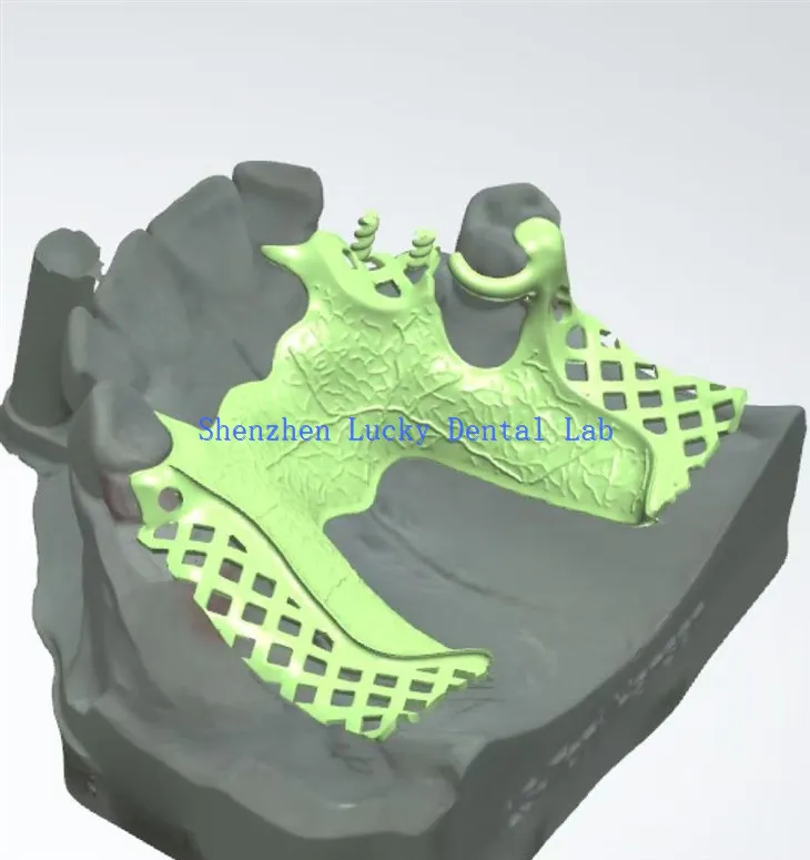 3D پرنٹ ڈینٹل میٹل فریم ورک مینوفیکچررز