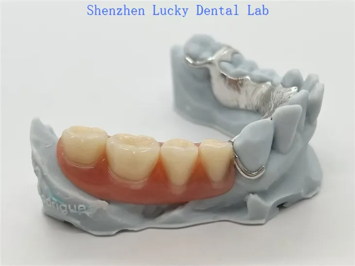 ایکریلک ڈینچرز کے ساتھ 3D پرنٹ میٹل سی آر سی آر فریم ورک