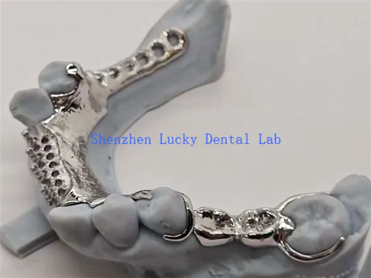 مصر کی پشت پناہی والے دانت ڈیزائن کے ساتھ تھری ڈی پرنٹ میٹل فریم ورک