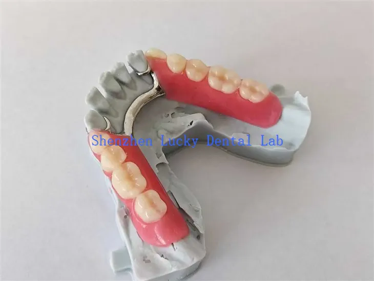 دھات کے فریم ورک کے ساتھ 3D پرنٹ جزوی ایکریلک ڈینچر دانتوں کی لیب میں آزمائیں