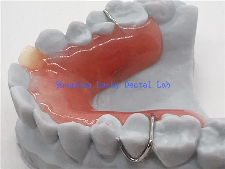 ایکریلک بیس کے ساتھ 3D پرنٹ ہٹنے والا جزوی دندان