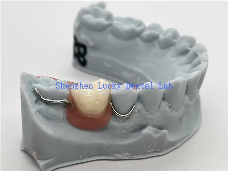 3D پرنٹ یکطرفہ ایکریلک ڈینچر