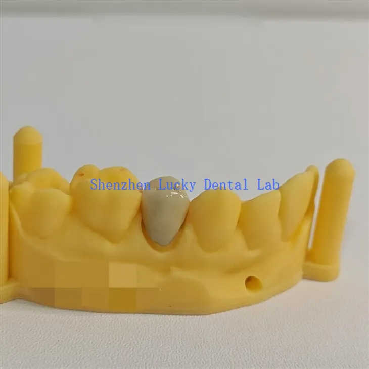 جمالیاتی 3D پرنٹ ڈینٹل پی ایف ایم سی او سی آر تاج مینوفیکچررز