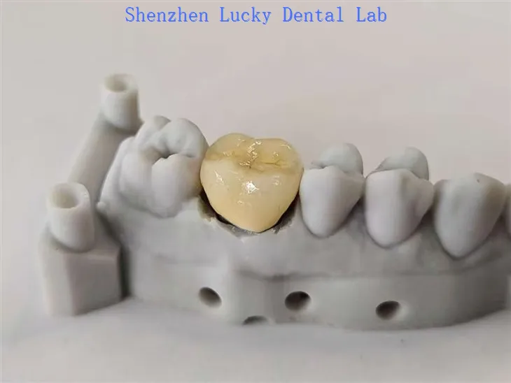 جمالیاتی دانتوں کا پی ایف ایم سی او سی آر کراؤن فیکٹری