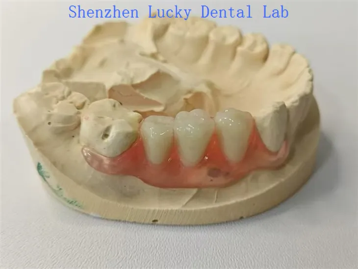 جمالیاتی دانتوں کا والپلاسٹ فلپر