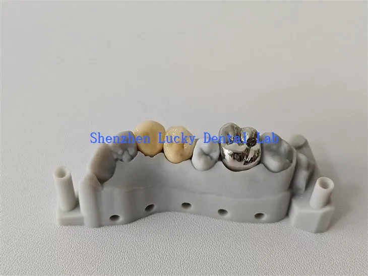 جمالیاتی 3D پرنٹ ایف ایم سی اور پی ایف ایم سی او سی آر تاج چین میں بنایا گیا ہے