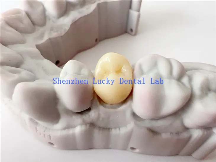 چین نے اپنی مرضی کے مطابق تھری ڈی پرنٹ ڈینٹل زرکونیا کا تاج