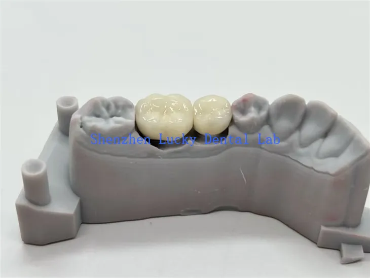 COCR مصر دات pfm دانتوں کے تاج