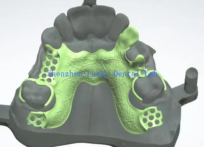 چین میں تیار کردہ تخصیص کردہ 3D پرنٹ ڈینٹل میٹل فریم ورک ڈیزائن
