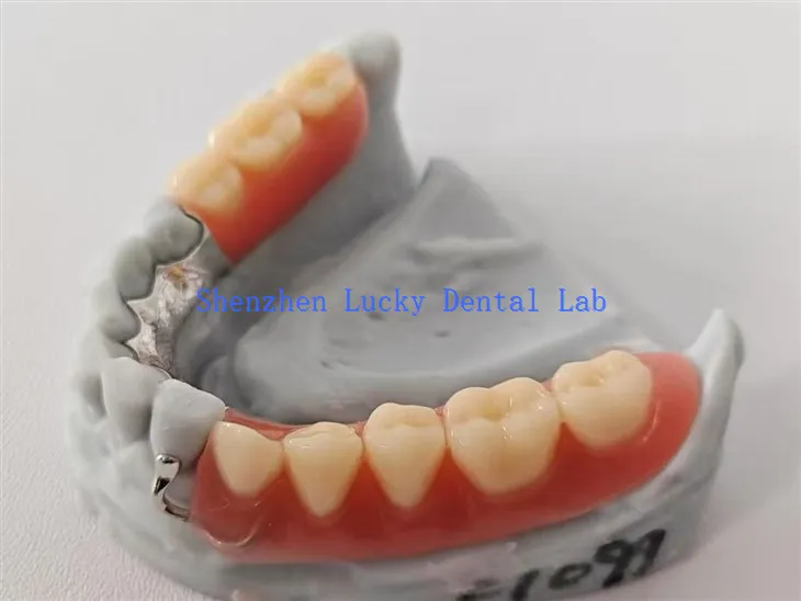 لسانی - پلیٹ میٹل فریم ورک ڈینٹل لیب کے ساتھ اپنی مرضی کے مطابق ایکریلک ڈینچر