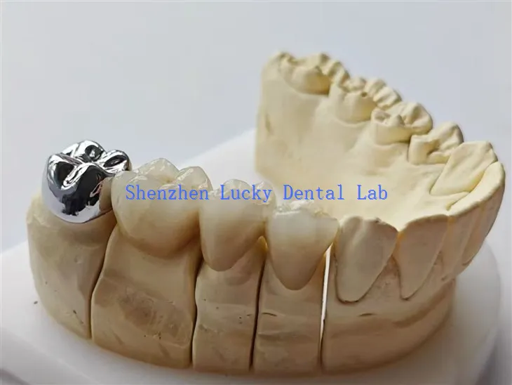 دانتوں کے مکمل دھات کے تاج کے ساتھ اپنی مرضی کے مطابق دانتوں کا PFM COCR پل