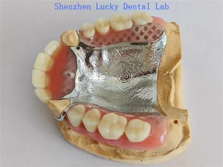 دھات پیلیٹل پلیٹ ڈینٹل لیب کے ساتھ اپنی مرضی کے مطابق جزوی ایکریلک ڈینچر