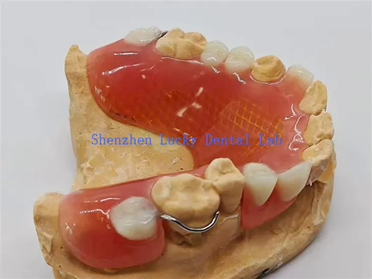 دھات کی میش کے ساتھ ہٹنے والا جزوی دندان