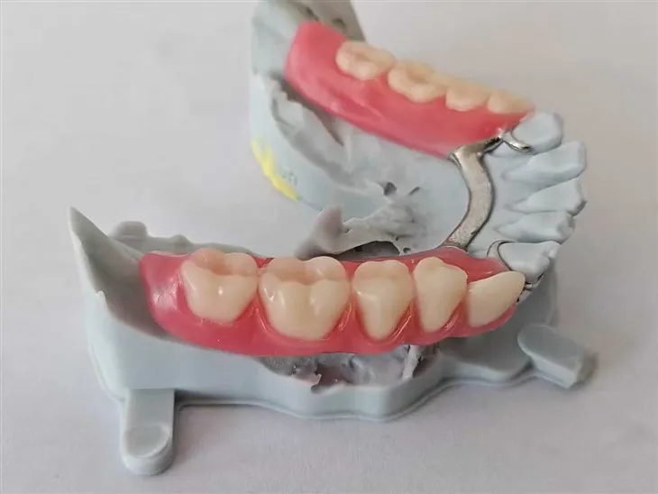 دھات کے فریم/بیس کے ساتھ دانتوں کا جزوی دانتوں کی کوشش کریں