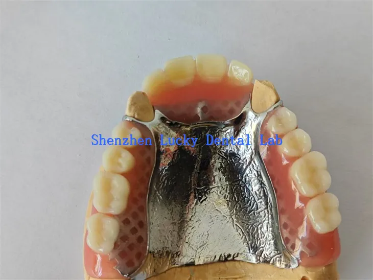 دھات کے پیلیٹل پلیٹ ڈینٹل لیب کے ساتھ زبردست جزوی ایکریلک ڈینچر