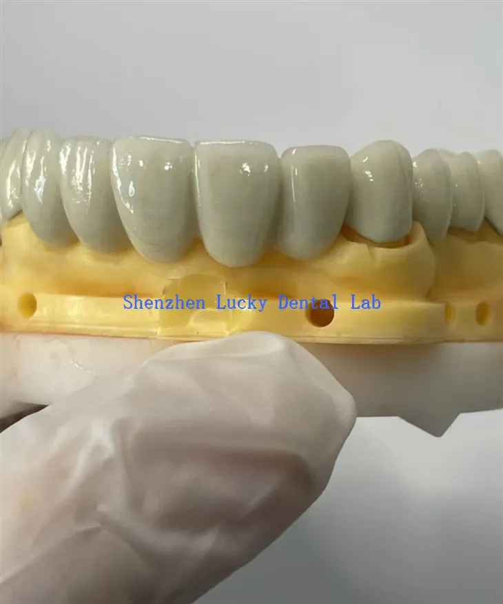 اپنی مرضی کے مطابق پی ایف ایم سی او سی آر ڈینٹل برج ڈینٹل لیب