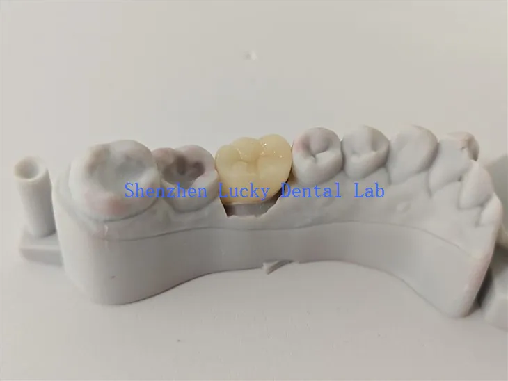 قدرتی دانتوں کے تمام سیرامک ​​آئی پی ایس ایمیکس کراؤن فیکٹری