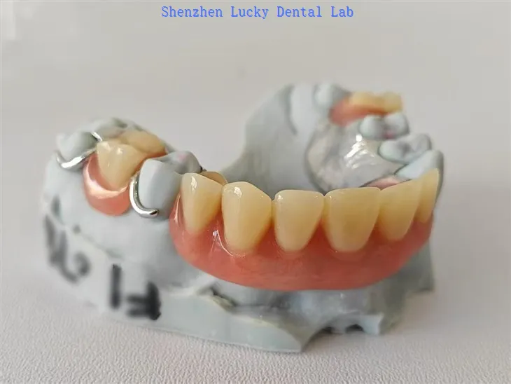 تار ہک دھات کے فریم ورک کے ساتھ جزوی ایکریلک ڈینچر