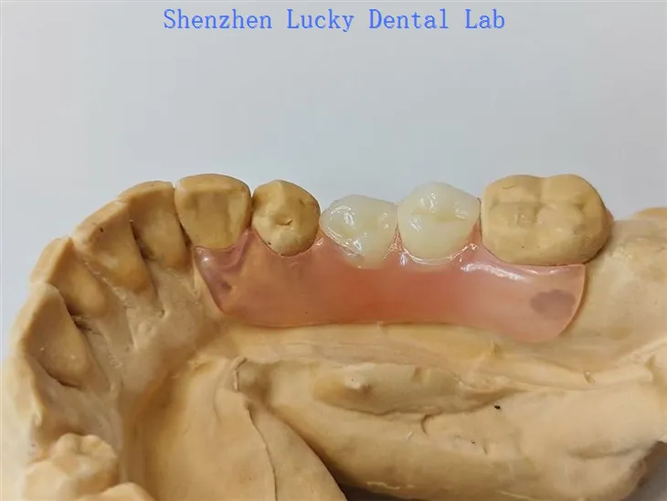 جزوی لچکدار دانتوں کا دانتوں کا ڈینچر والپلاسٹ ہک مینوفیکچررز کے ساتھ