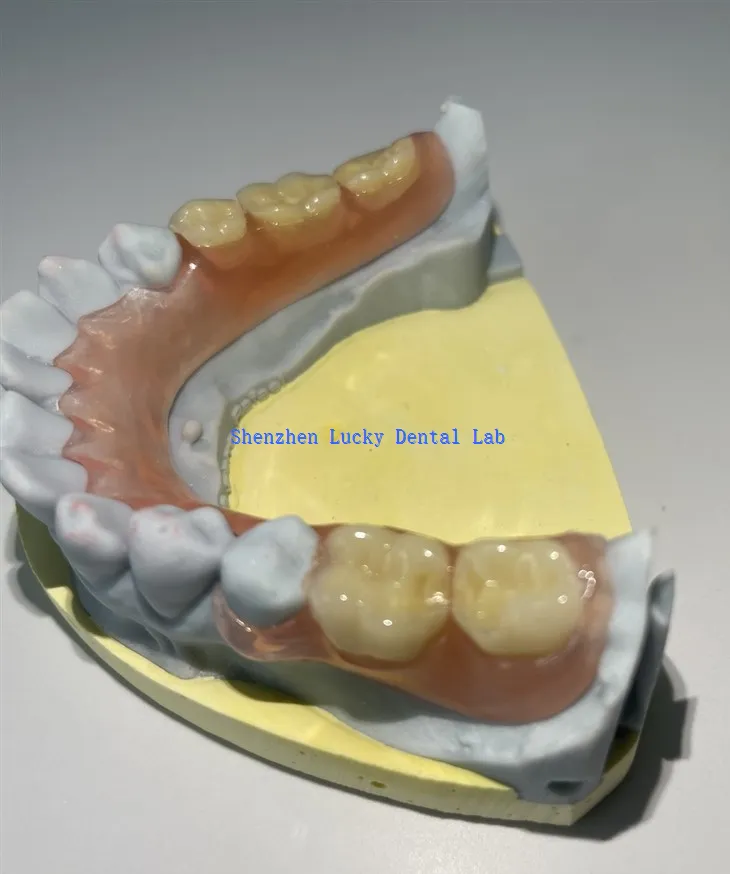 جزوی لچکدار دندان