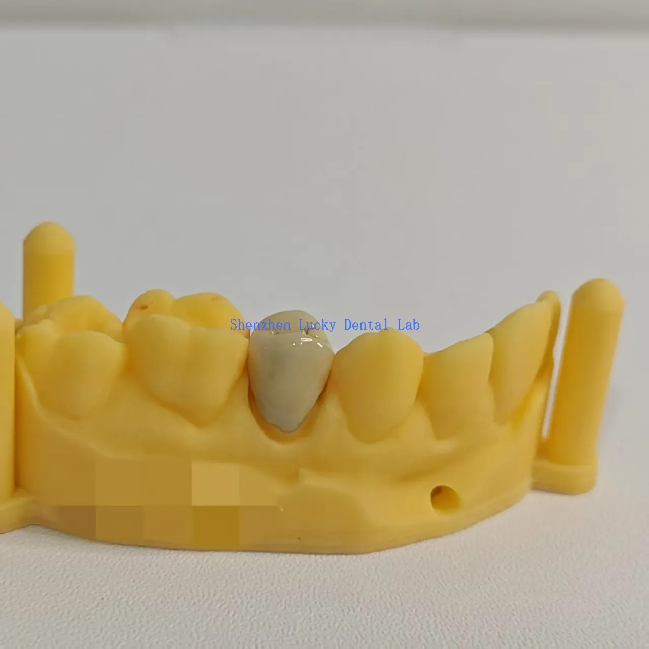 PFM Cocr Crown PFM Cocr Crown