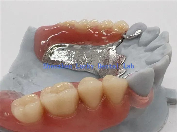 ایکریلک ڈینچر کے ساتھ والپلاسٹ ہک دھات کا فریم ورک