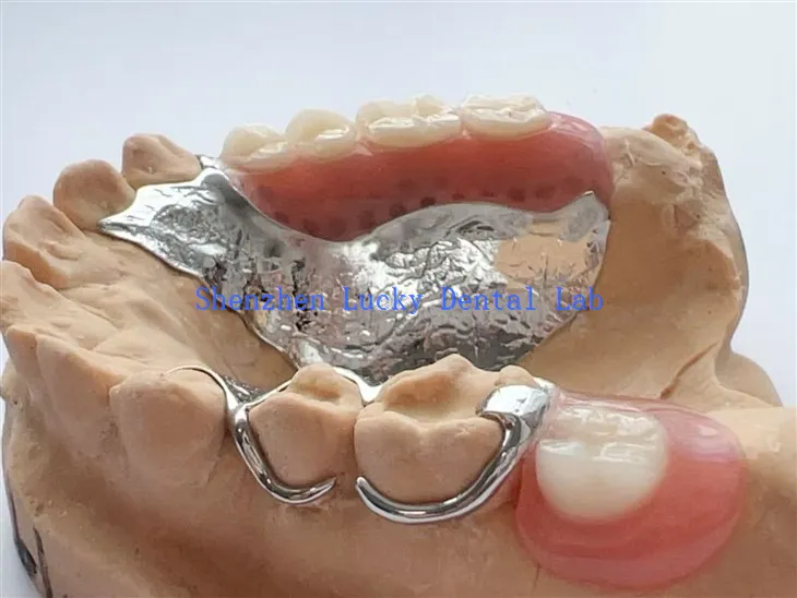 جزوی ایکریلک ڈینچر کے ساتھ تار ہکاس ڈینٹل میٹل فریم ورک